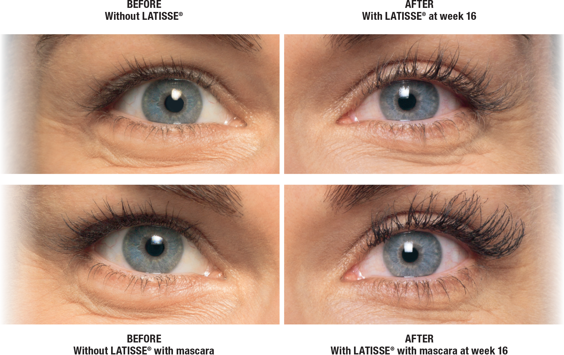 Before and after Latisse result | Bella Derma Laser & Med Spa | Eagleville, PA