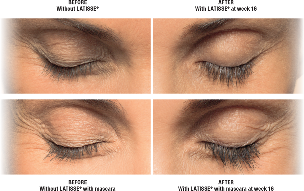 Patient before and after Latisse result with eyes close | Bella Derma Laser & Med Spa | Eagleville, PA