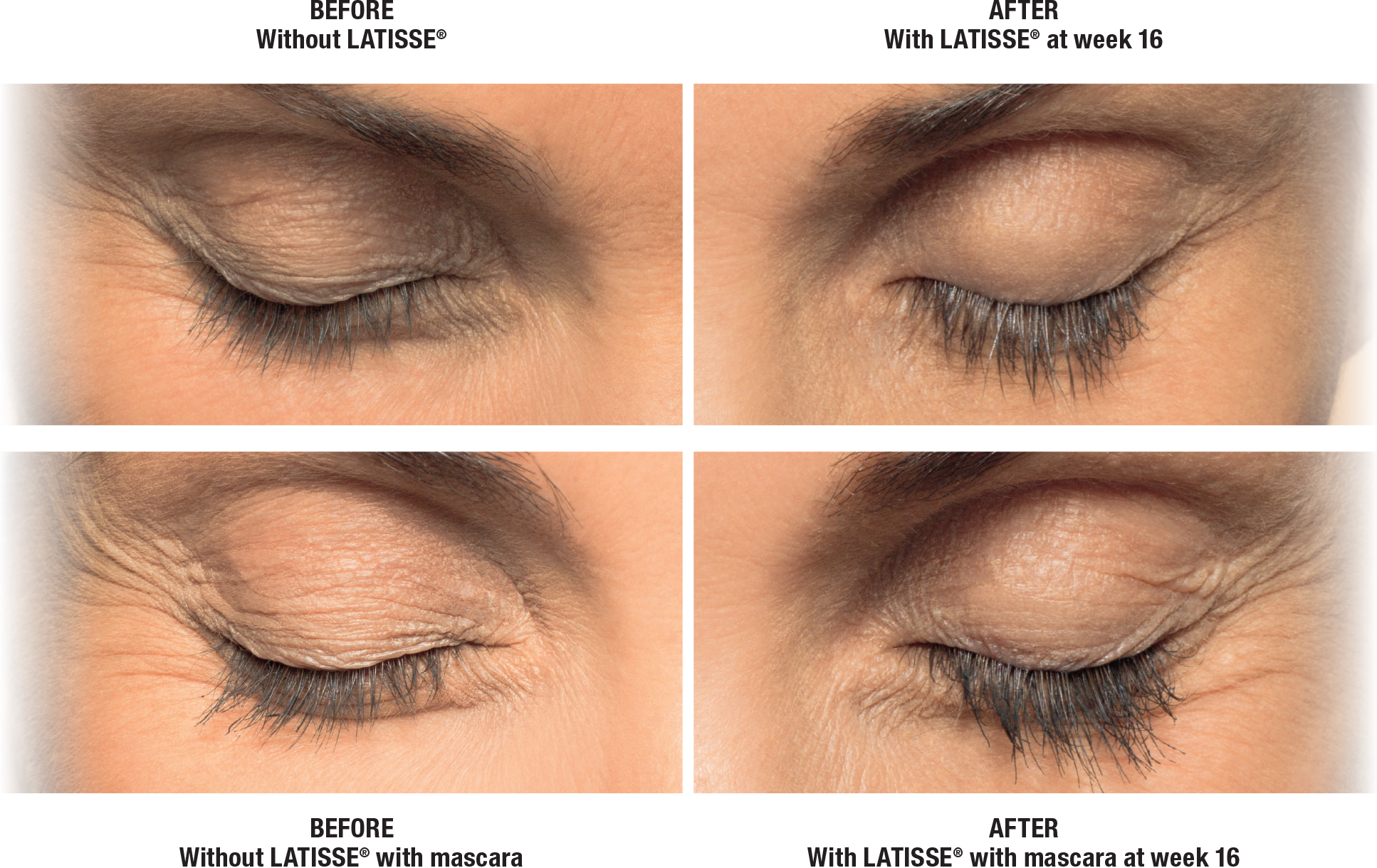 Patient before and after Latisse result with eyes close | Bella Derma Laser & Med Spa | Eagleville, PA