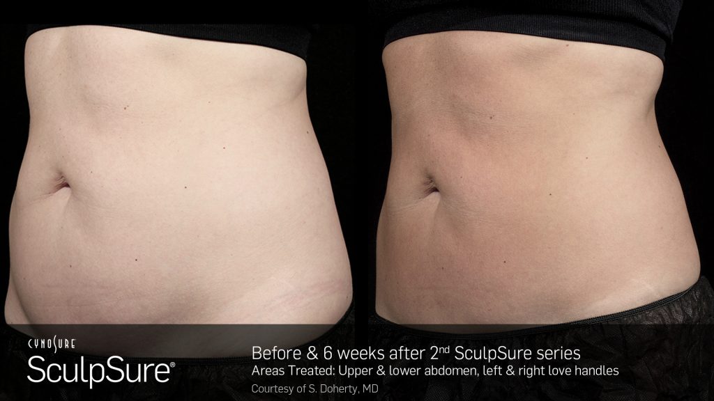 CynoSure SculpSure patient after 2nd sculpsure series | Bella Derma Laser & Med Spa | Eagleville, PA
