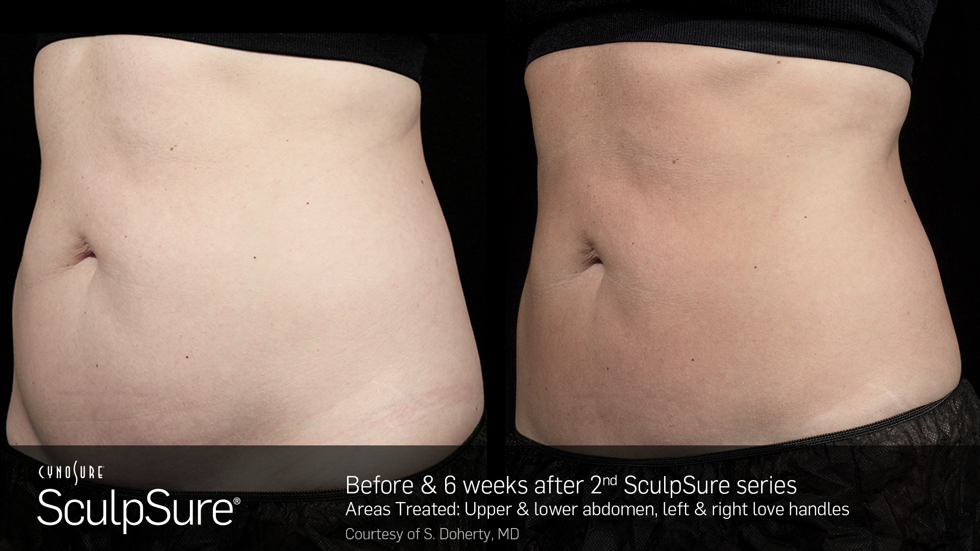 CynoSure SculpSure patient after 2nd sculpsure series | Bella Derma Laser & Med Spa | Eagleville, PA