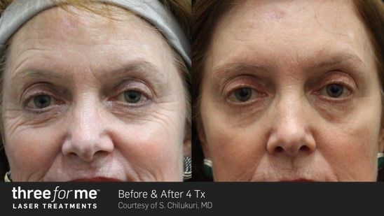 Three for Me Patient before and after result | Bella Derma Laser & Med Spa | Eagleville, PA
