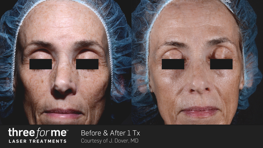 Three for Me Patient before and after photos | Bella Derma Laser & Med Spa | Eagleville, PA