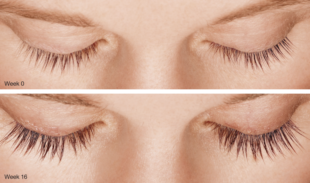 Latisse Close-up look, result from 0 to 16 weeks | Bella Derma Laser & Med Spa | Eagleville, PA