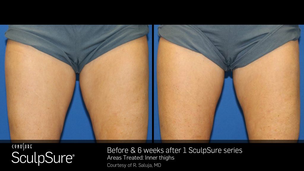 CynoSure SculpSure patient after 1 sculpsure series | Bella Derma Laser & Med Spa | Eagleville, PA