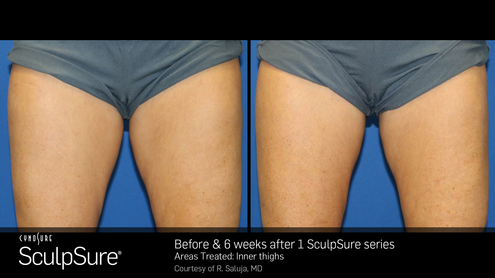 CynoSure SculpSure patient after 1 sculpsure series | Bella Derma Laser & Med Spa | Eagleville, PA