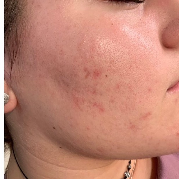 Acne Scar Female After | Bella Derma Laser & Med Spa | Eagleville, PA