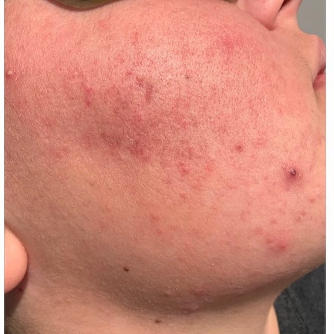 Acne Scar Female Before | Bella Derma Laser & Med Spa | Eagleville, PA