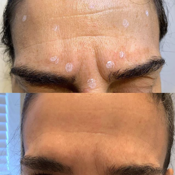 Botox Before And After | Bella Derma Laser & Med Spa | Eagleville, PA