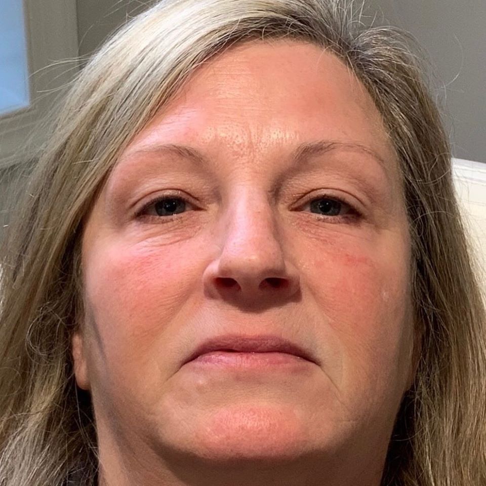 Female Filler After | Bella Derma Laser & Med Spa | Eagleville, PA