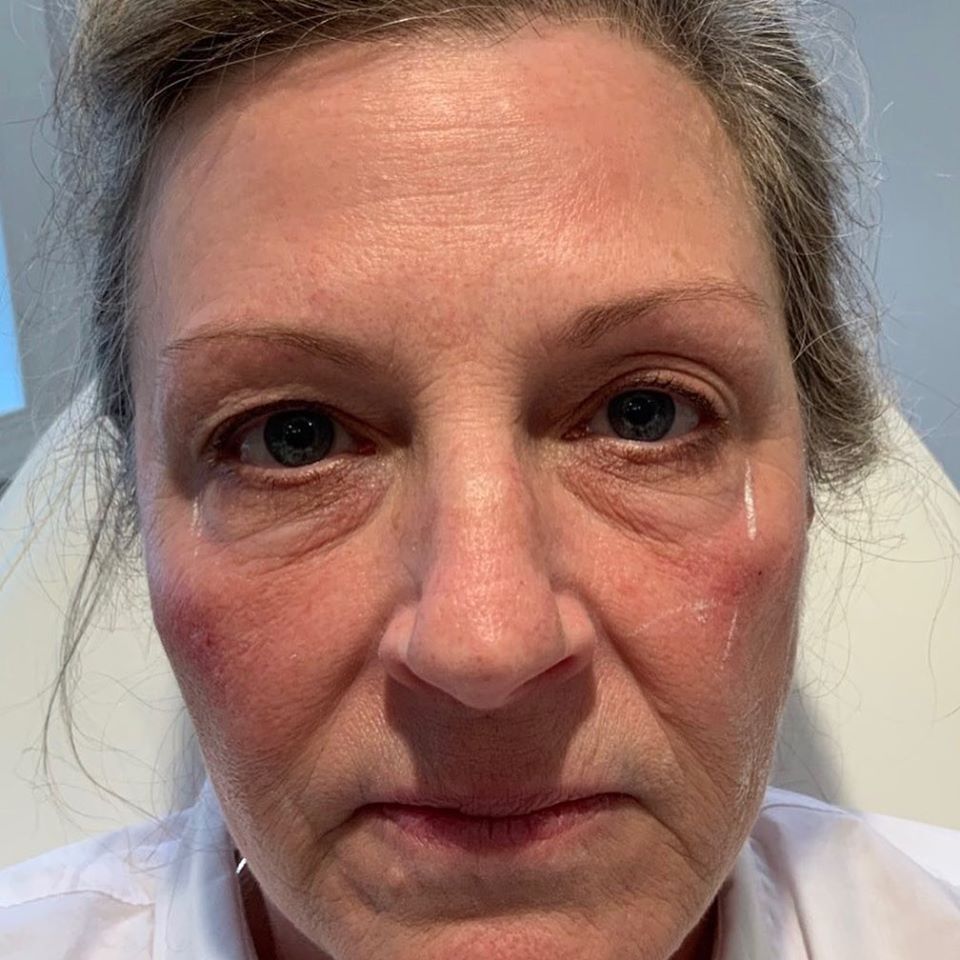 Female Filler Before | Bella Derma Laser & Med Spa | Eagleville, PA