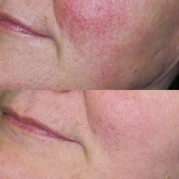 Skin Revitalization Before And After | Bella Derma Laser & Med Spa | Eagleville, PA