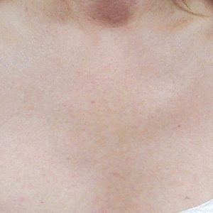 Skin Revitilization Female After | Bella Derma Laser & Med Spa | Eagleville, PA