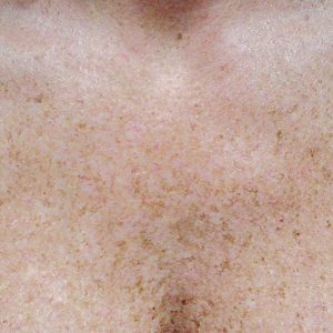 Skin Revitilization Female Before | Bella Derma Laser & Med Spa | Eagleville, PA