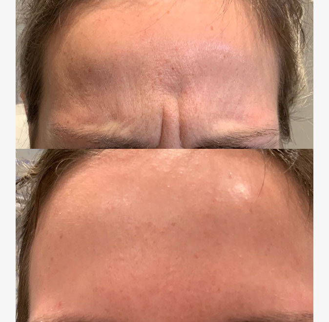 Botox Collegeville, Bella Derma Laser and Med Spa Botox Before and After Picr