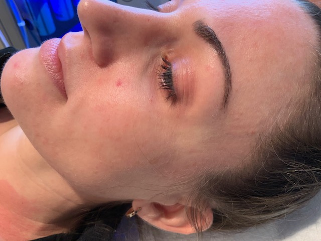 Bella Derma Laser and Med Spa in Collegeville PA Skin Revitalization Treatment