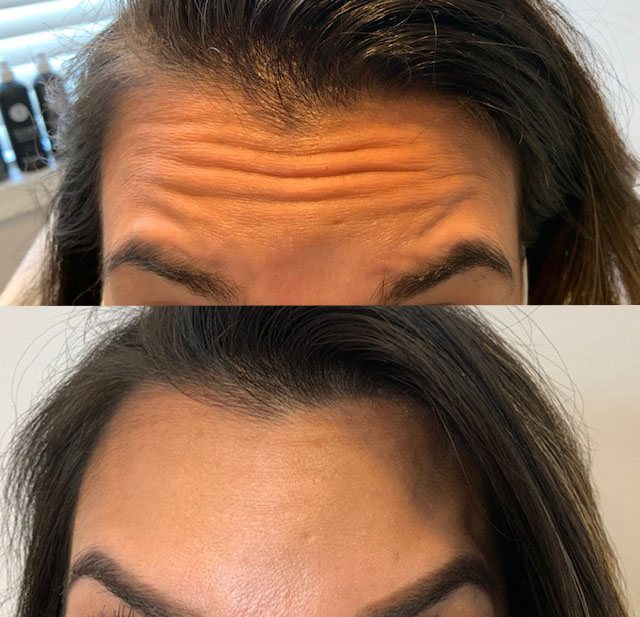 Bella Derma Laser and Med Spa Botox Before and After Image