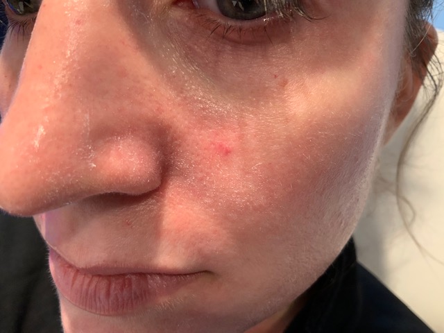 Skin Resurfacing Before | Bella Derma Laser & Med Spa | Eagleville, PA