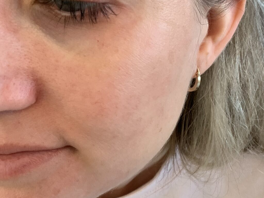 Skin Resurfacing | Bella Derma Laser & Med Spa | Eagleville, PA