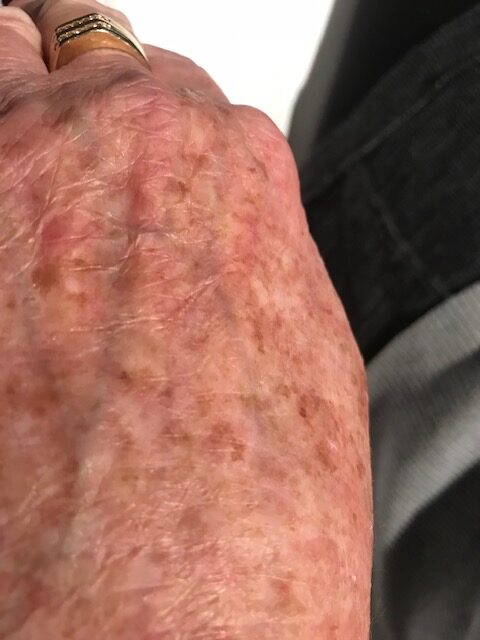 Skin Treatment | Bella Derma Laser & Med Spa | Eagleville, PA
