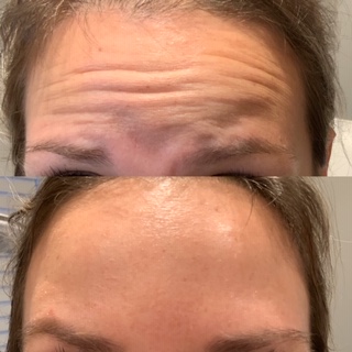 Botox Collegeville, Bella Derma Laser and Med Spa Botox Before and After