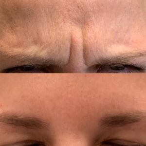 Botox Collegeville, Bella Derma Laser and Med Spa Botox Before and After