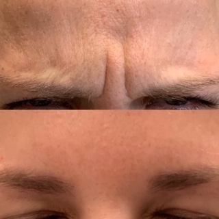 Botox Collegeville, Bella Derma Laser and Med Spa Botox Before and After