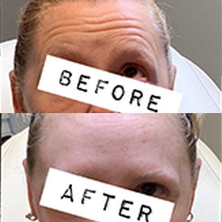 Botox Collegeville
