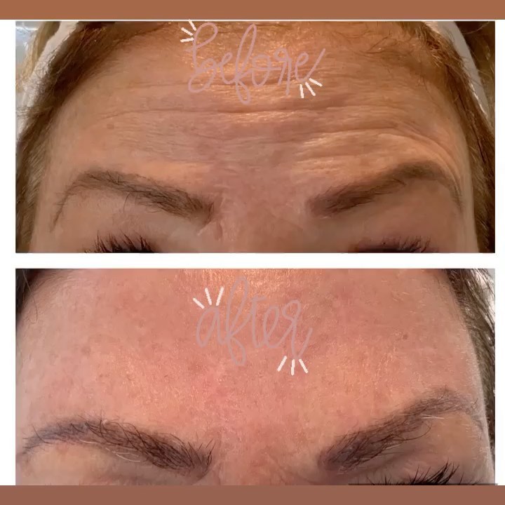 Botox Before After Image | Bella Derma Laser & Med Spa | Eagleville, PA