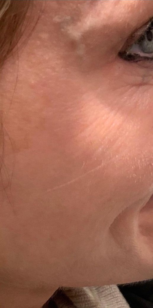 Botox Crow Feet After | Bella Derma Laser & Med Spa | Eagleville, PA