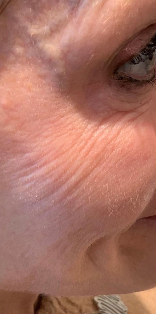 Botox Crow Feet Before | Bella Derma Laser & Med Spa | Eagleville, PA