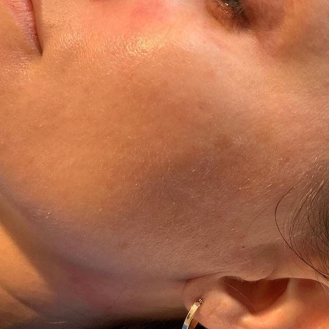 Hydra Glow Image | Bella Derma Laser & Med Spa | Eagleville, PA