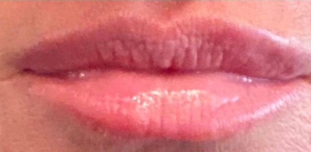 Lip After | Bella Derma Laser & Med Spa | Eagleville, PA