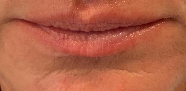 Lip Before | Bella Derma Laser & Med Spa | Eagleville, PA