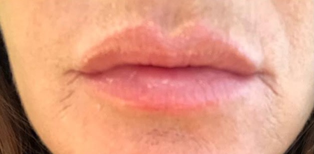 Lip After Image | Bella Derma Laser & Med Spa | Eagleville, PA
