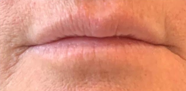 Lip Before Image | Bella Derma Laser & Med Spa | Eagleville, PA
