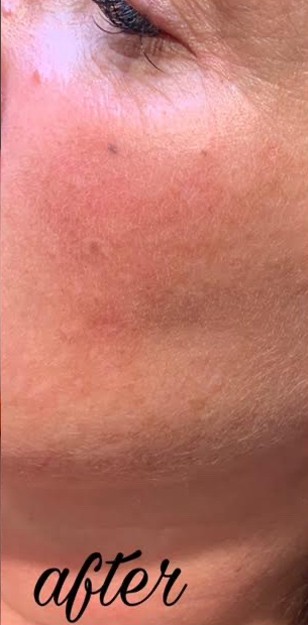 Skin Resurfacing After | Bella Derma Laser & Med Spa | Eagleville, PA