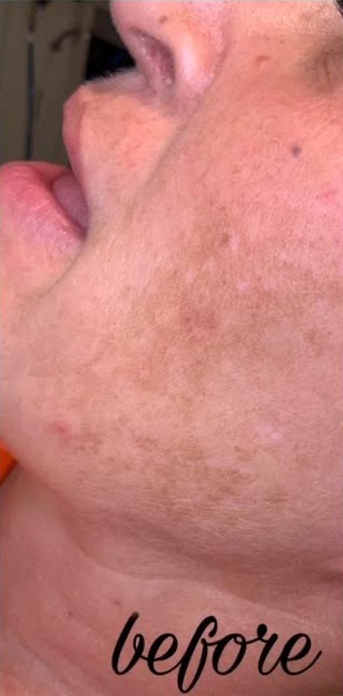 Skin Resurfacing Before | Bella Derma Laser & Med Spa | Eagleville, PA