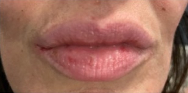 Bella Derma Laser and Med Spa Lip Filler