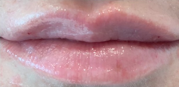 Bella Derma Laser and Med Spa Lip Filler
