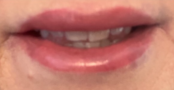 Bella Derma Laser and Med Spa Lip Filler