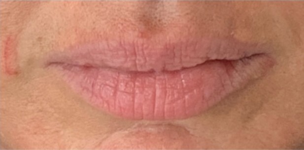 Bella Derma Laser and Med Spa Lip Filler