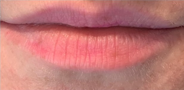 Bella Derma Laser and Med Spa Lip Filler