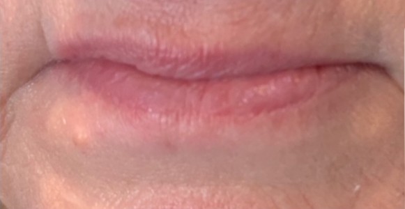 Bella Derma Laser and Med Spa Lip Filler