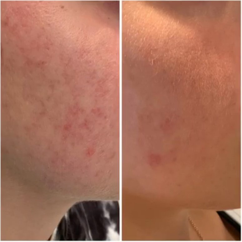 Bella Derma Laser and Med Spa Acne Scars and Skin Tone