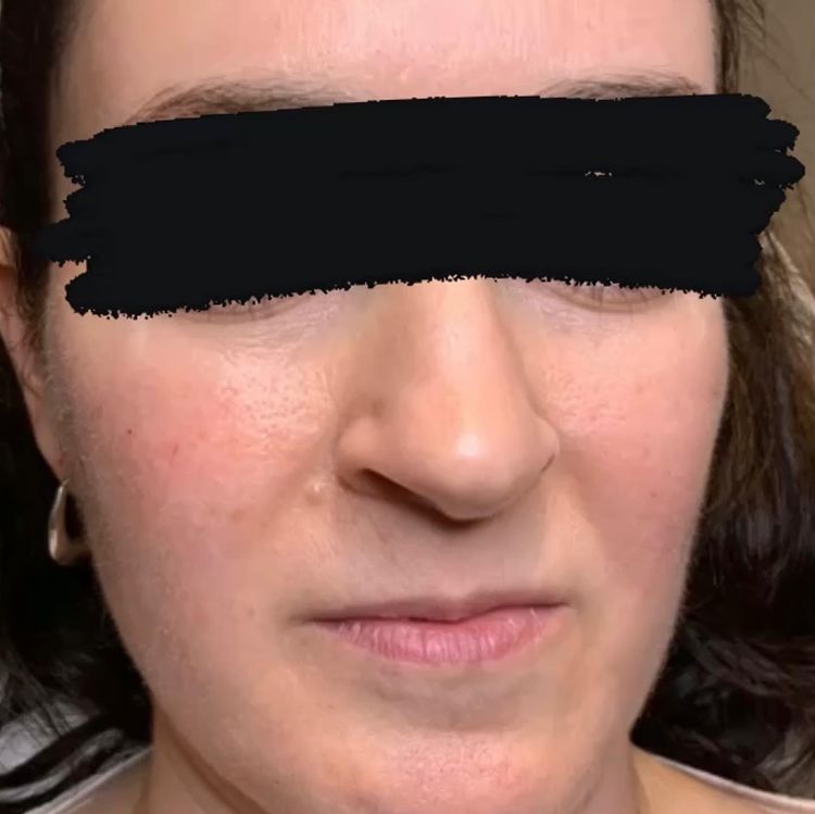 Bella Derma Laser and Med Spa Facial Filler Treatment