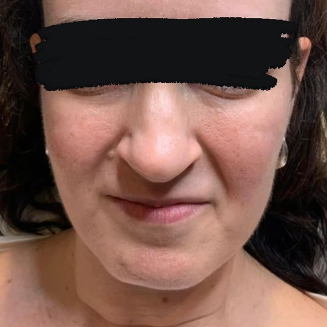 Bella Derma Laser and Med Spa Acne Scars and Skin Tone