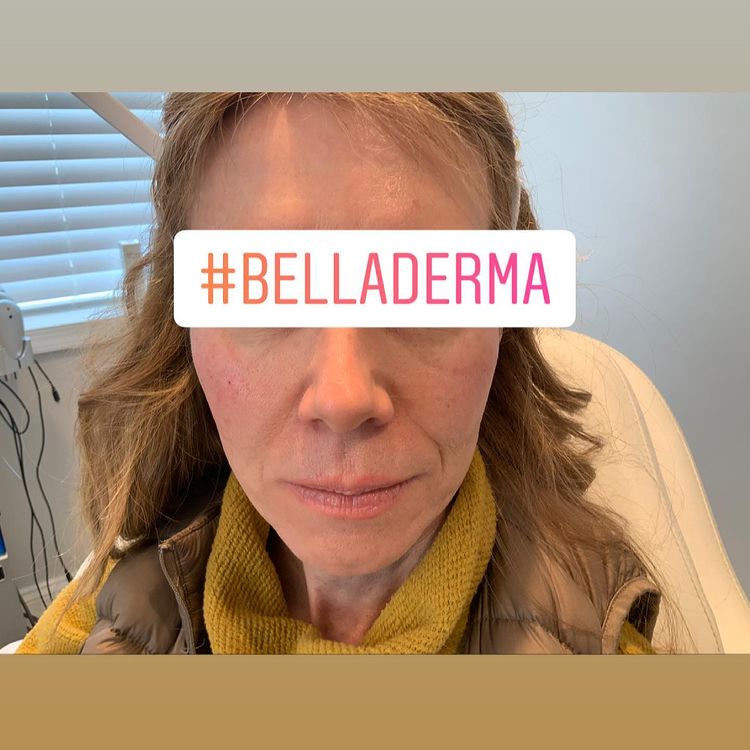 Bella Derma Laser and Med Spa Facial Filler Treament