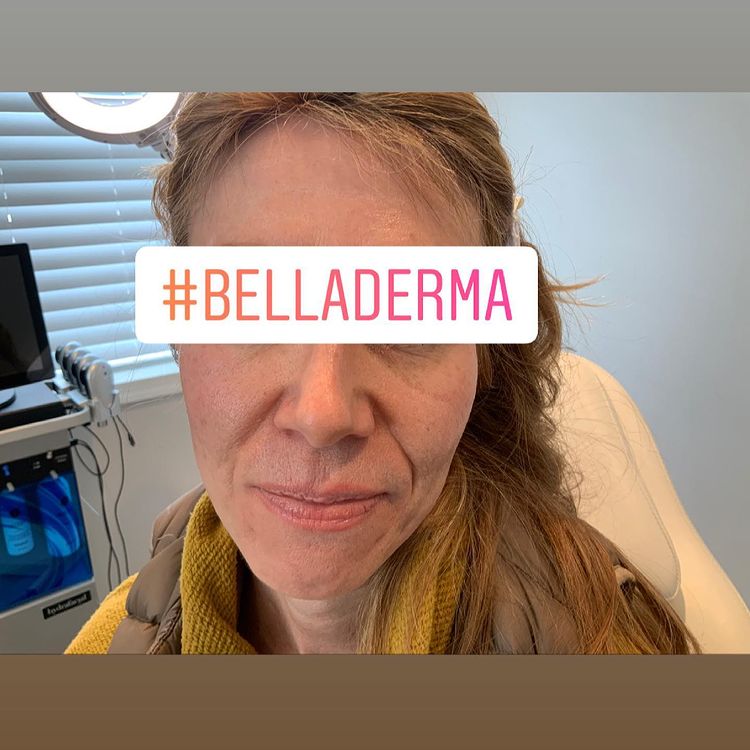 Bella Derma Laser and Med Spa Scars and Skin Tone