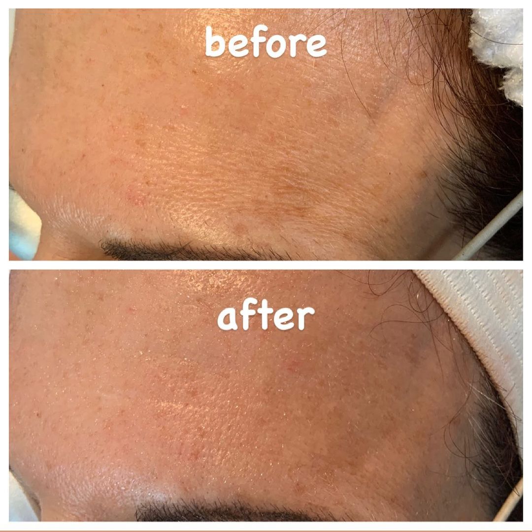Bella Derma Laser and Med Spa Acne Scars and Skin Tone